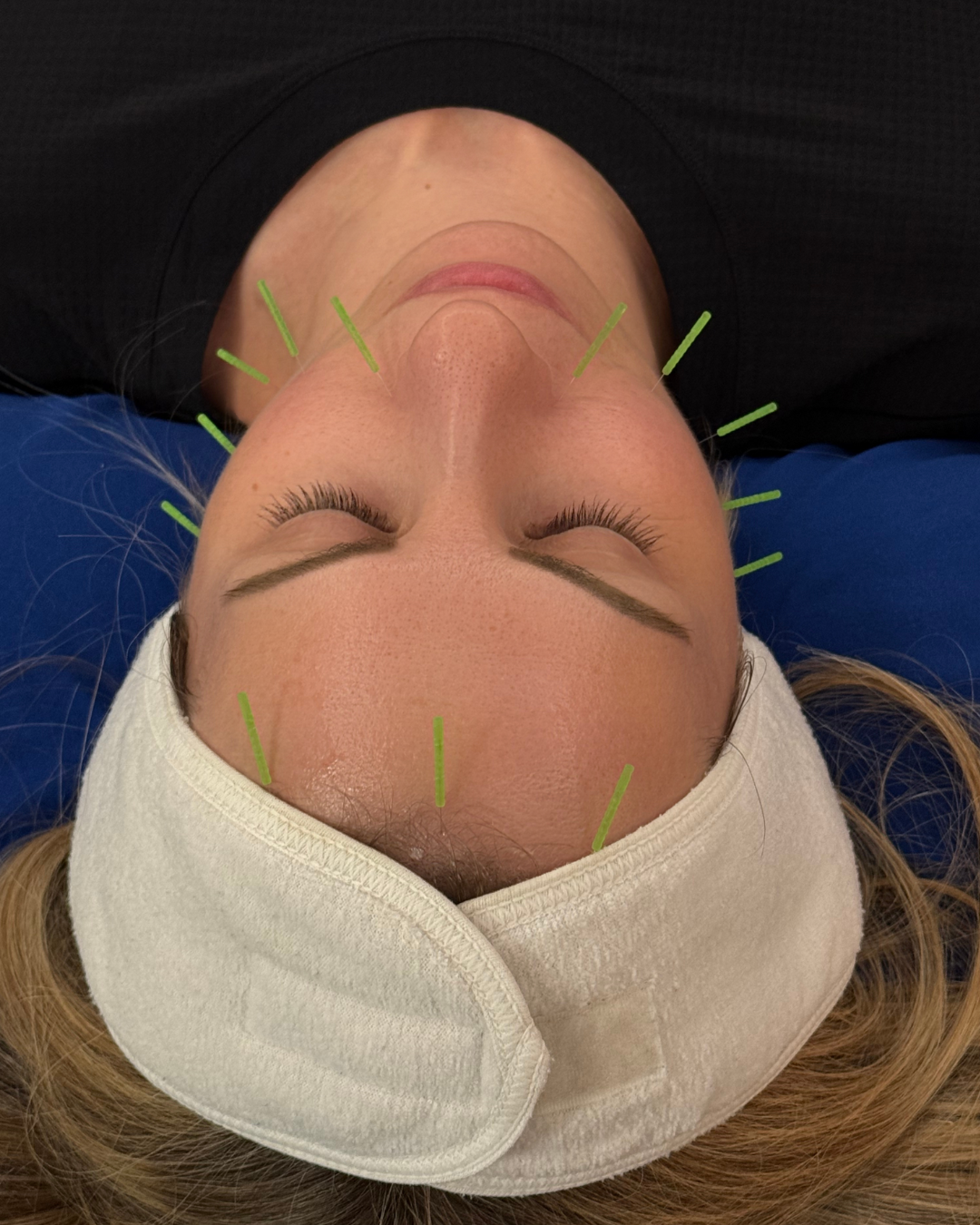Person receiving cosmetic acupuncture