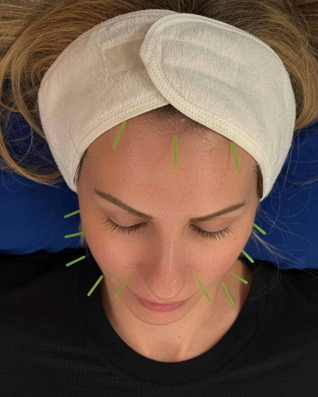 Person receiving microneedling