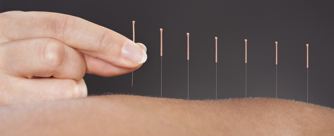Acupuncture