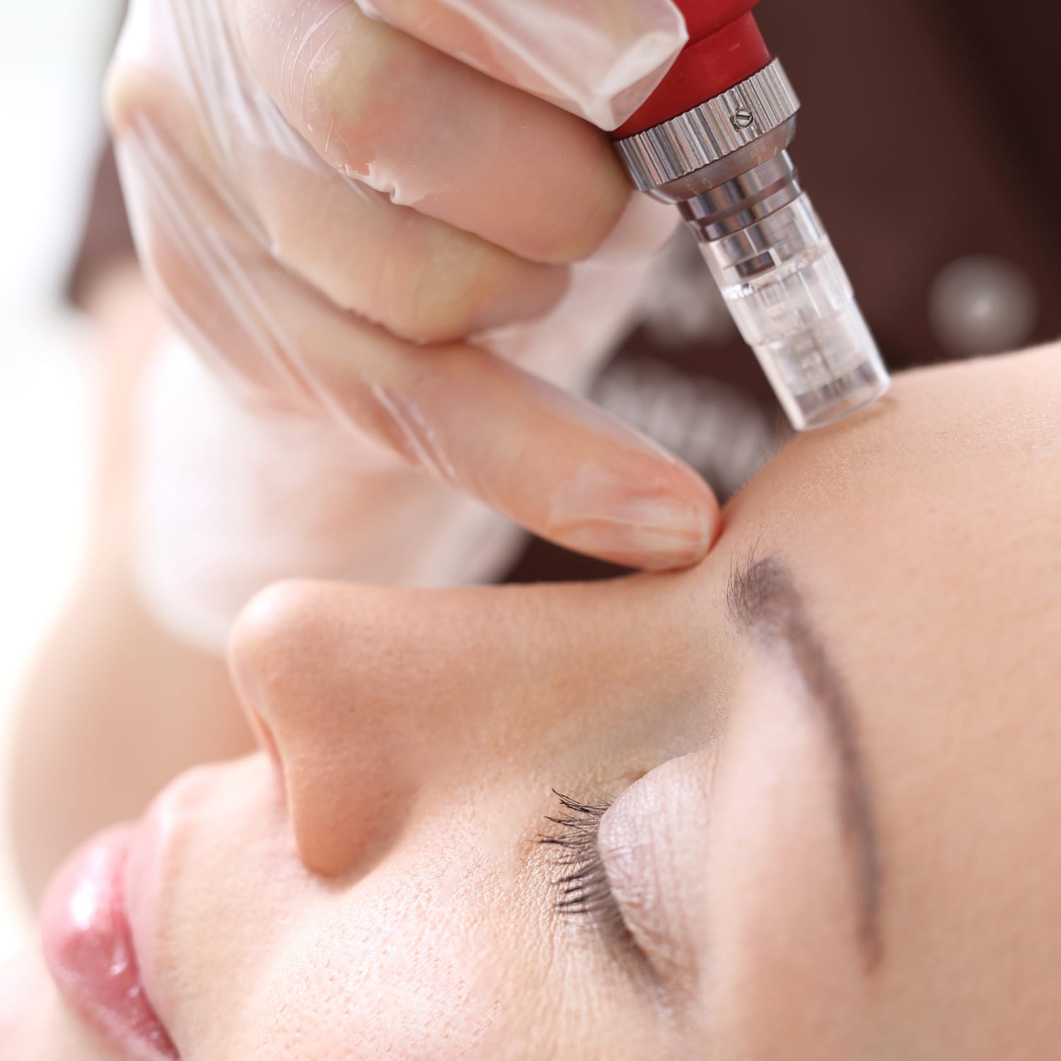 Person receiving microneedling